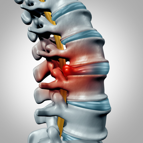 Chiropractors can address a pinched nerve.
