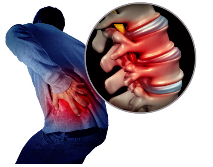 Guide to Sciatica Pain and Treatment Options
